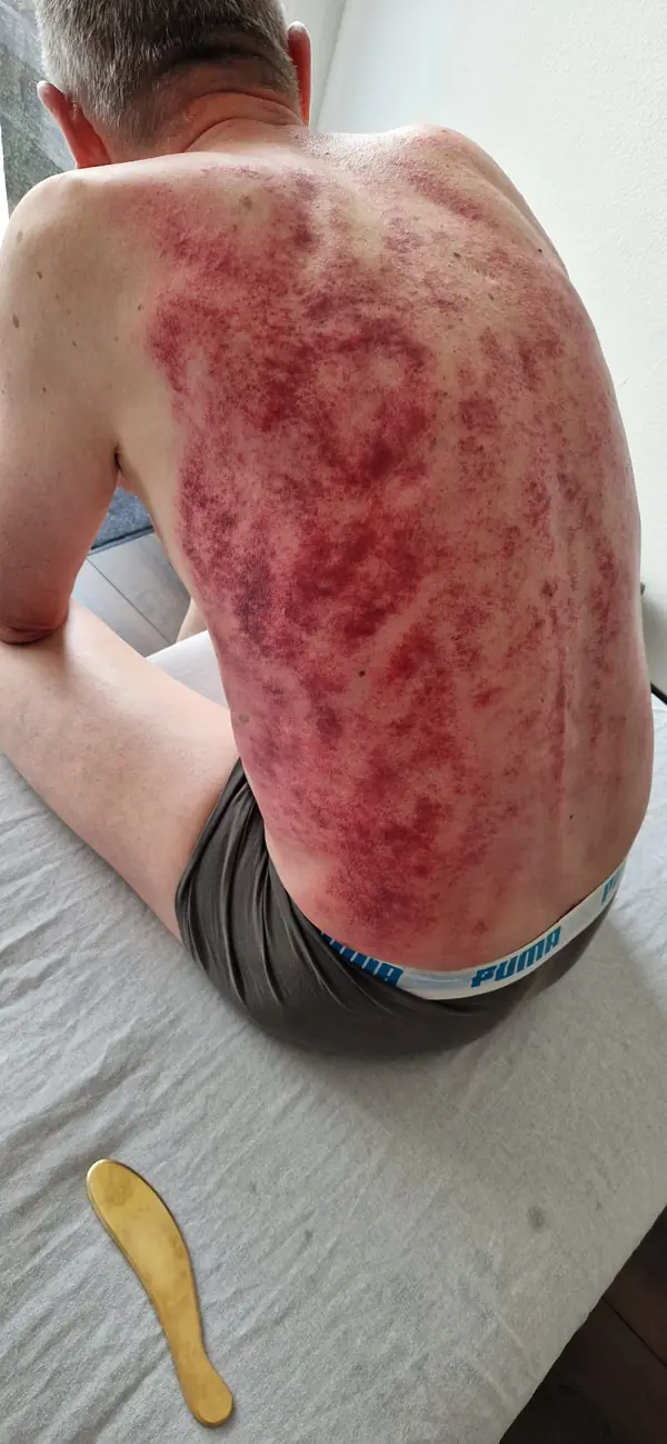 Marques de Gua Sha sur le dos, avec l’instrument posé sur la table