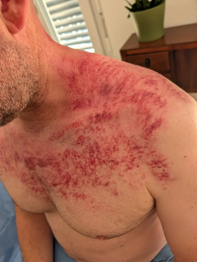 Marques de Gua Sha sur l’épaule et la nuque après une séance