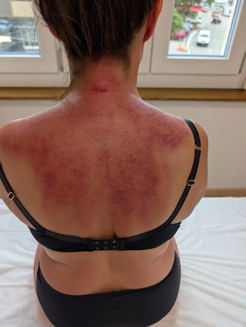 Marques de Gua Sha sur le haut du dos et les trapèzes